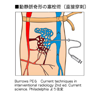 動静脈奇形の塞栓術（直接穿刺）