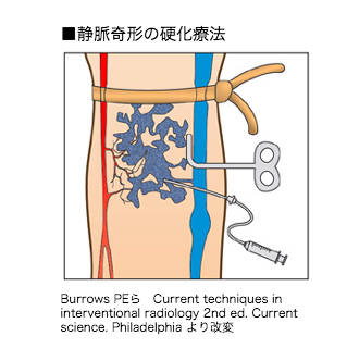 静脈奇形の硬化療法